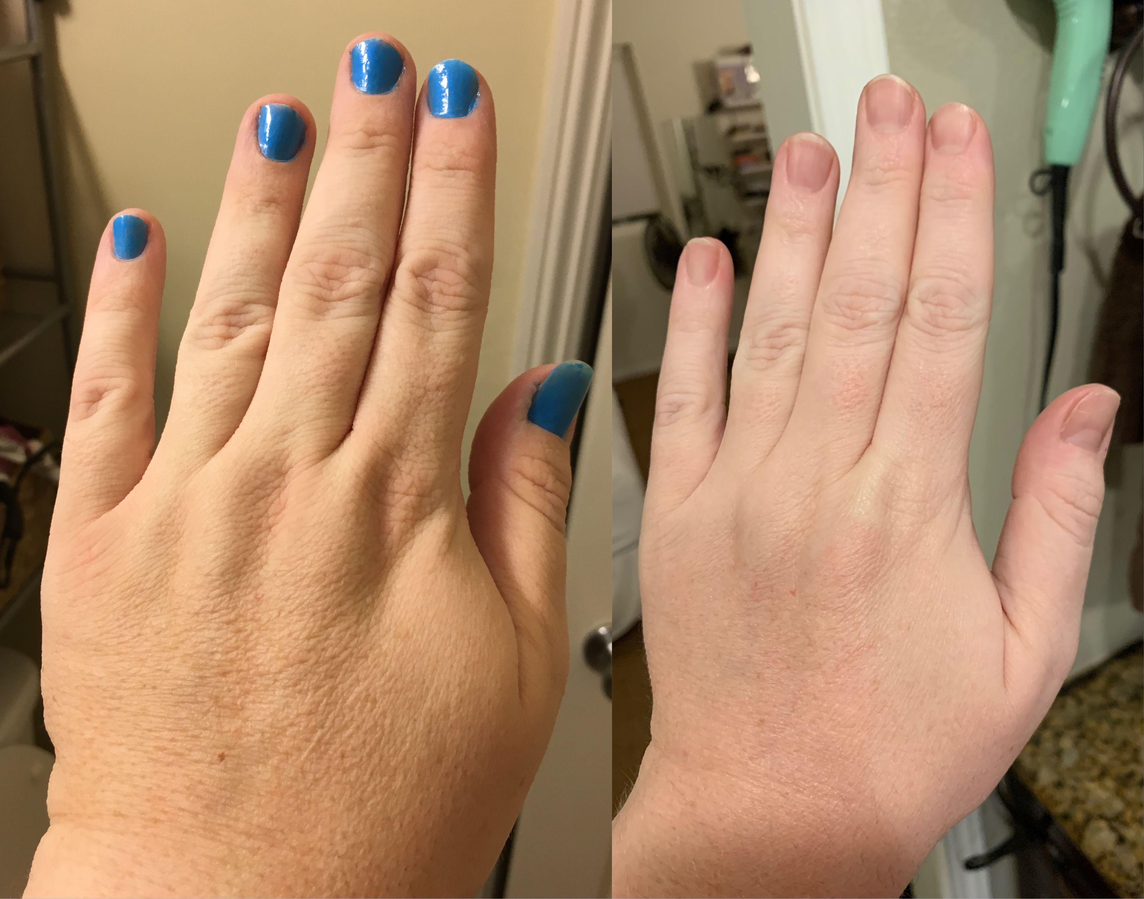 Two right hands, side by side. The hand on the left is pre-transition and much thicker than the hand on the right.